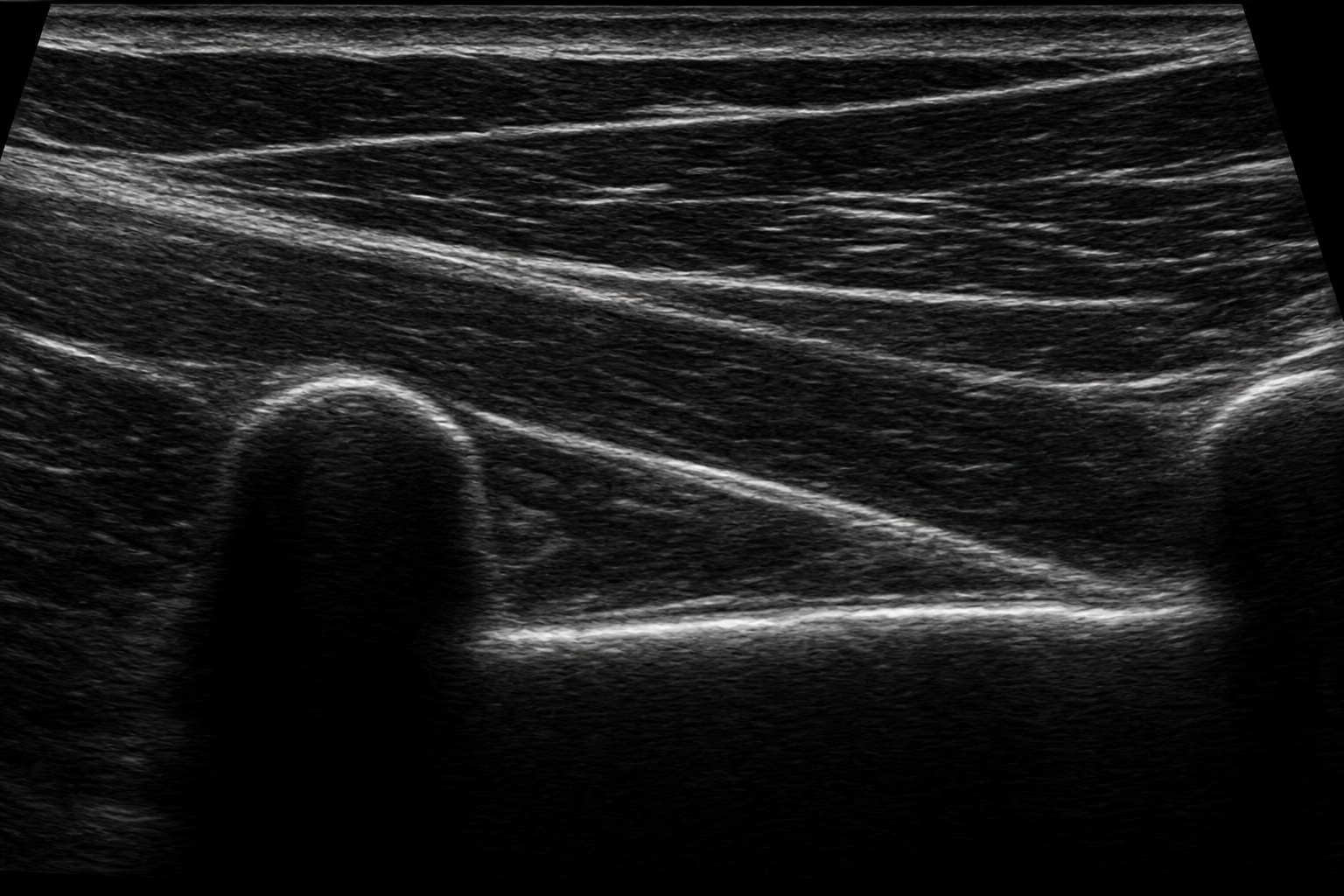 Imagem ultrassonográfica educacional simulada do espaço paravertebral torácico, sem marcações.